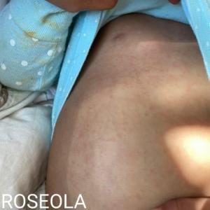 roseola baby rash skin bumps fever virus dark black skin hispanic ethnic