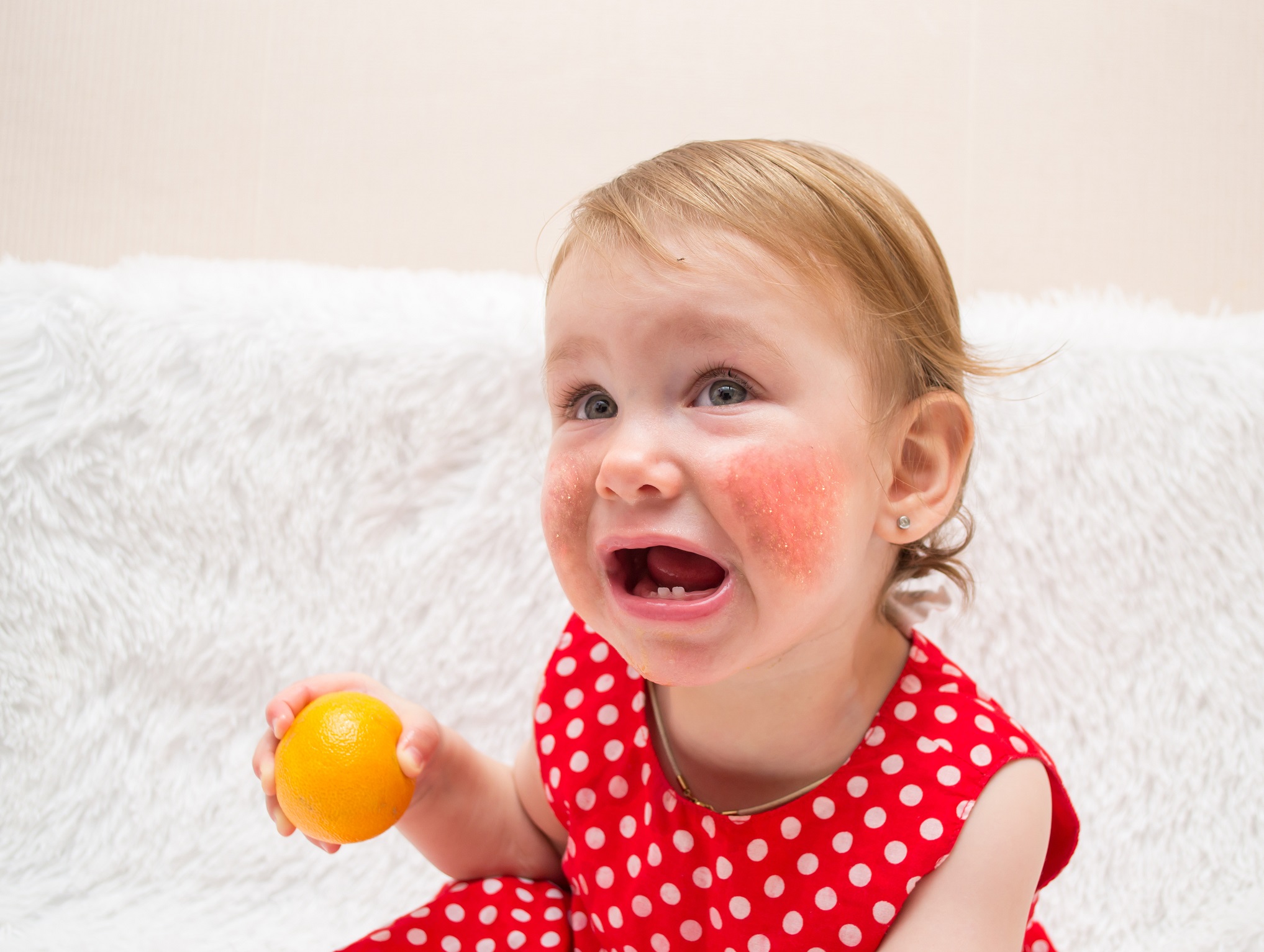 girl with eczema