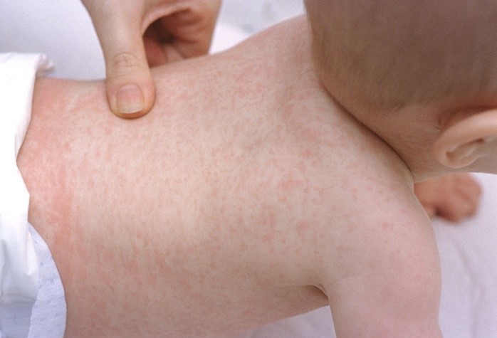 roseola rash skin virus bumps fever baby toddler sick