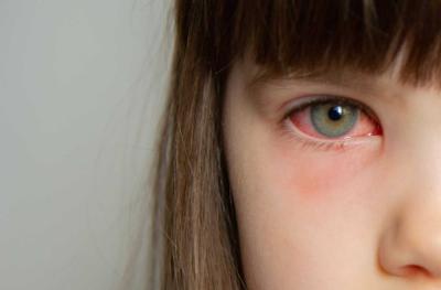 girl with pink eye